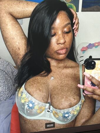freckledn